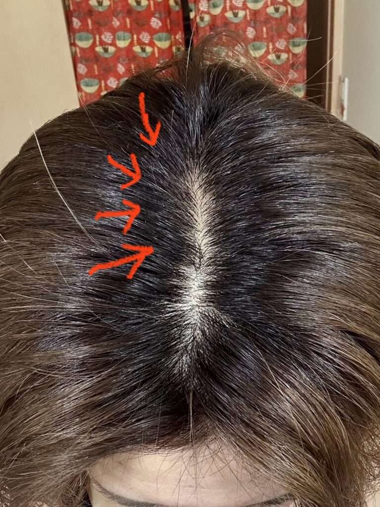 アドーブシャンプーとトリートメントを1ヶ月使用した頭頂部の比較写真。白髪が減り、髪のハリやツヤが出ている様子。