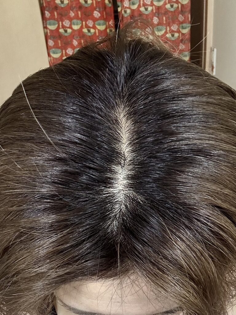 アドーブシャンプーを1ヶ月使用した頭皮の変化。白髪が減り、髪のツヤとハリが出てきた様子。